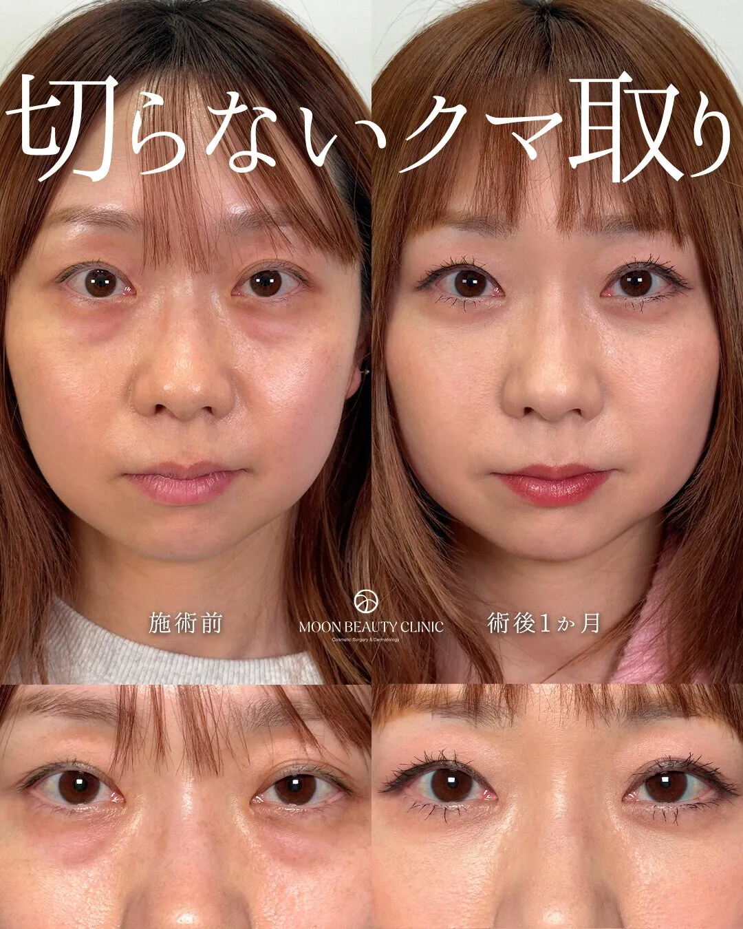 切らないクマ取り_1 Before/After