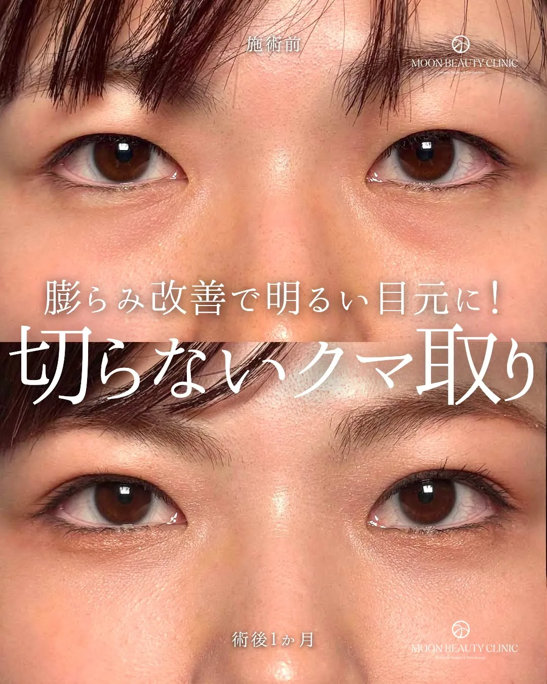 切らないクマ取り_10 Before/After