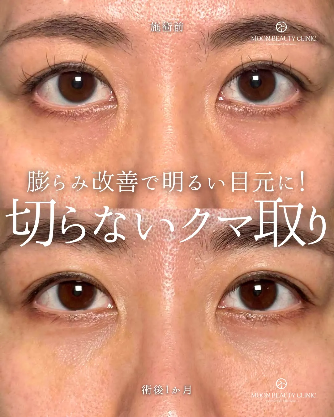 切らないクマ取り_11 Before/After