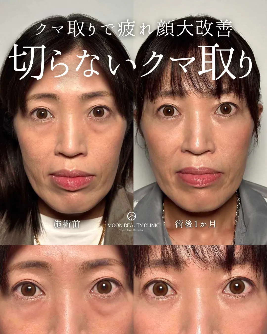 切らないクマ取り_12 Before/After
