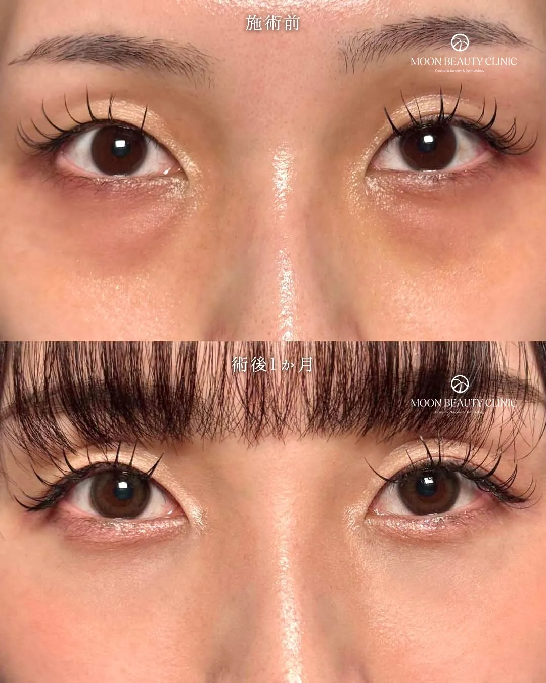 切らないクマ取り_13 Before/After