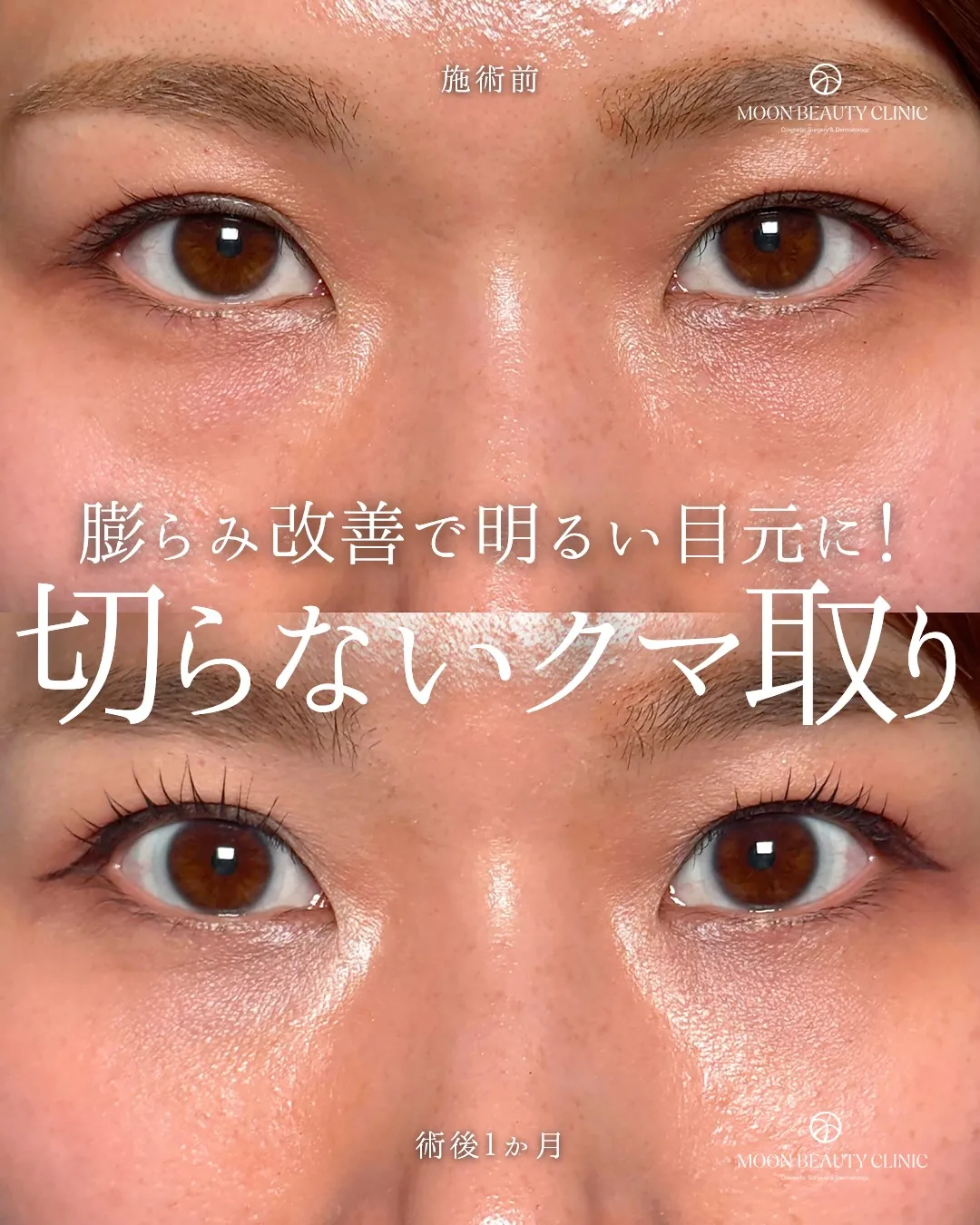 切らないクマ取り_14 Before/After