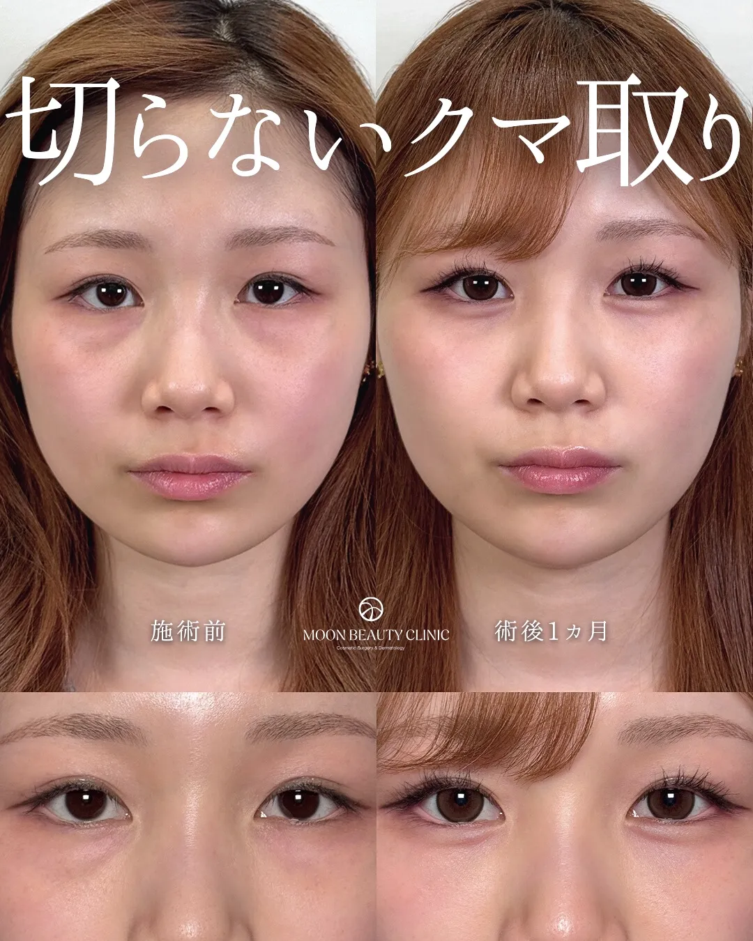 切らないクマ取り_2 Before/After