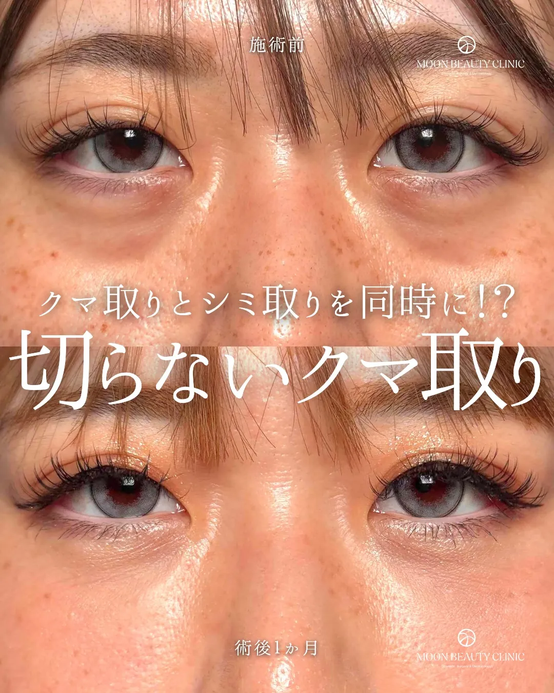切らないクマ取り_3 Before/After