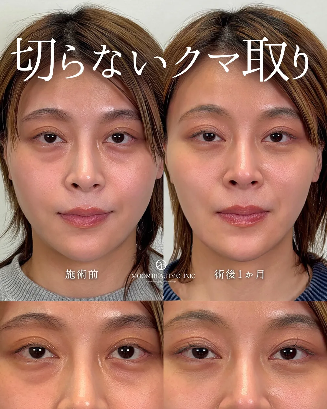 切らないクマ取り_4 Before/After