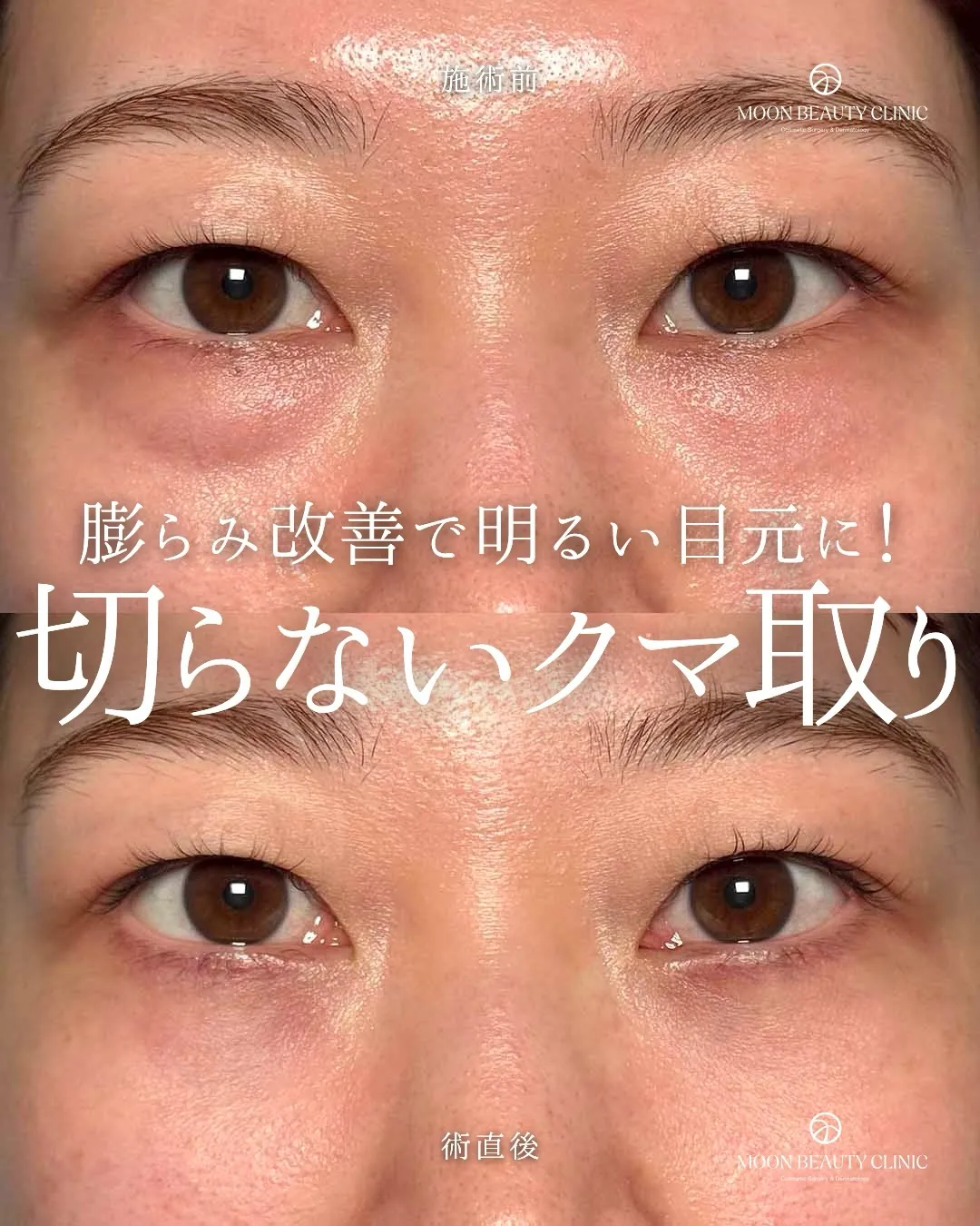 切らないクマ取り_5 Before/After
