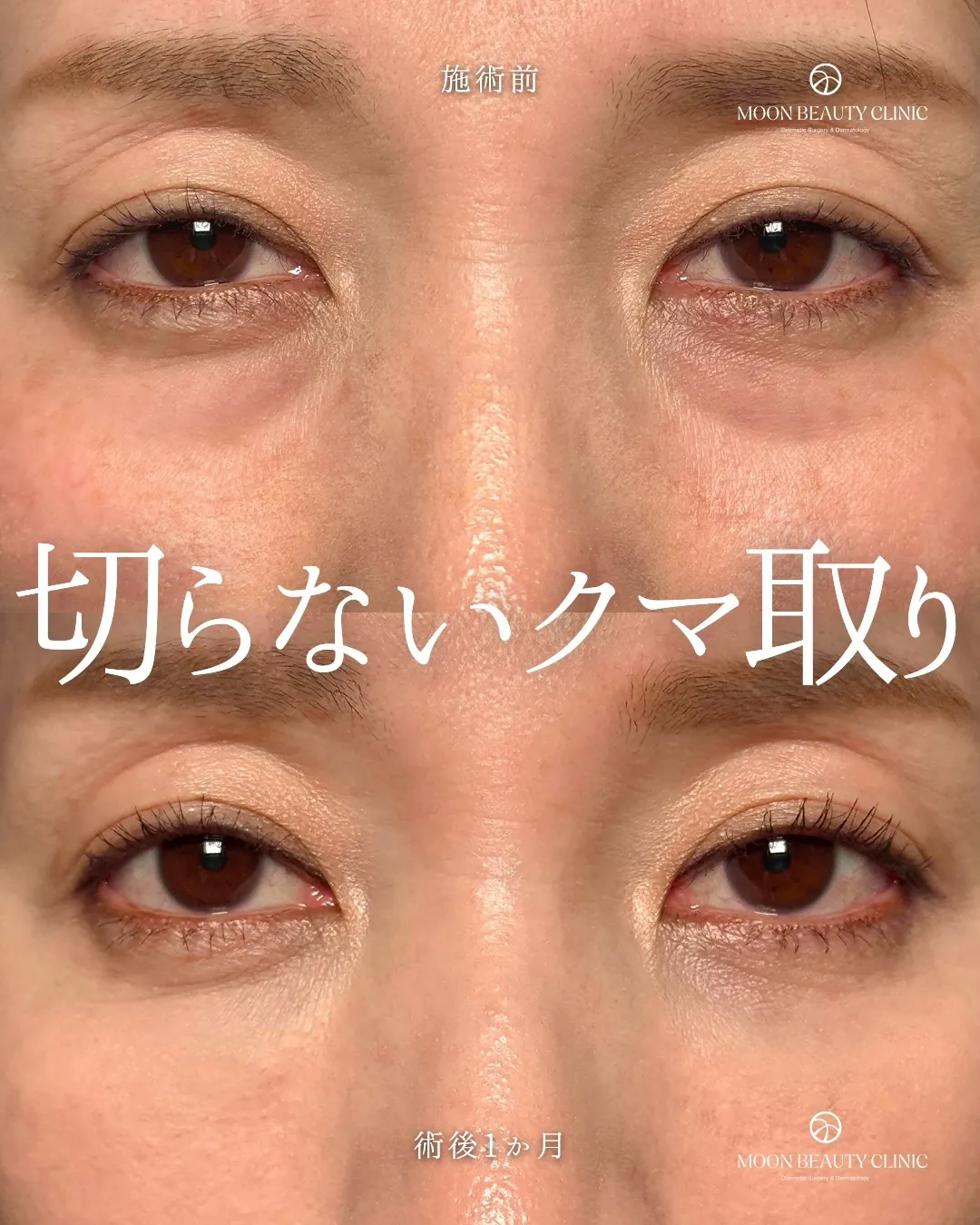 切らないクマ取り_6 Before/After