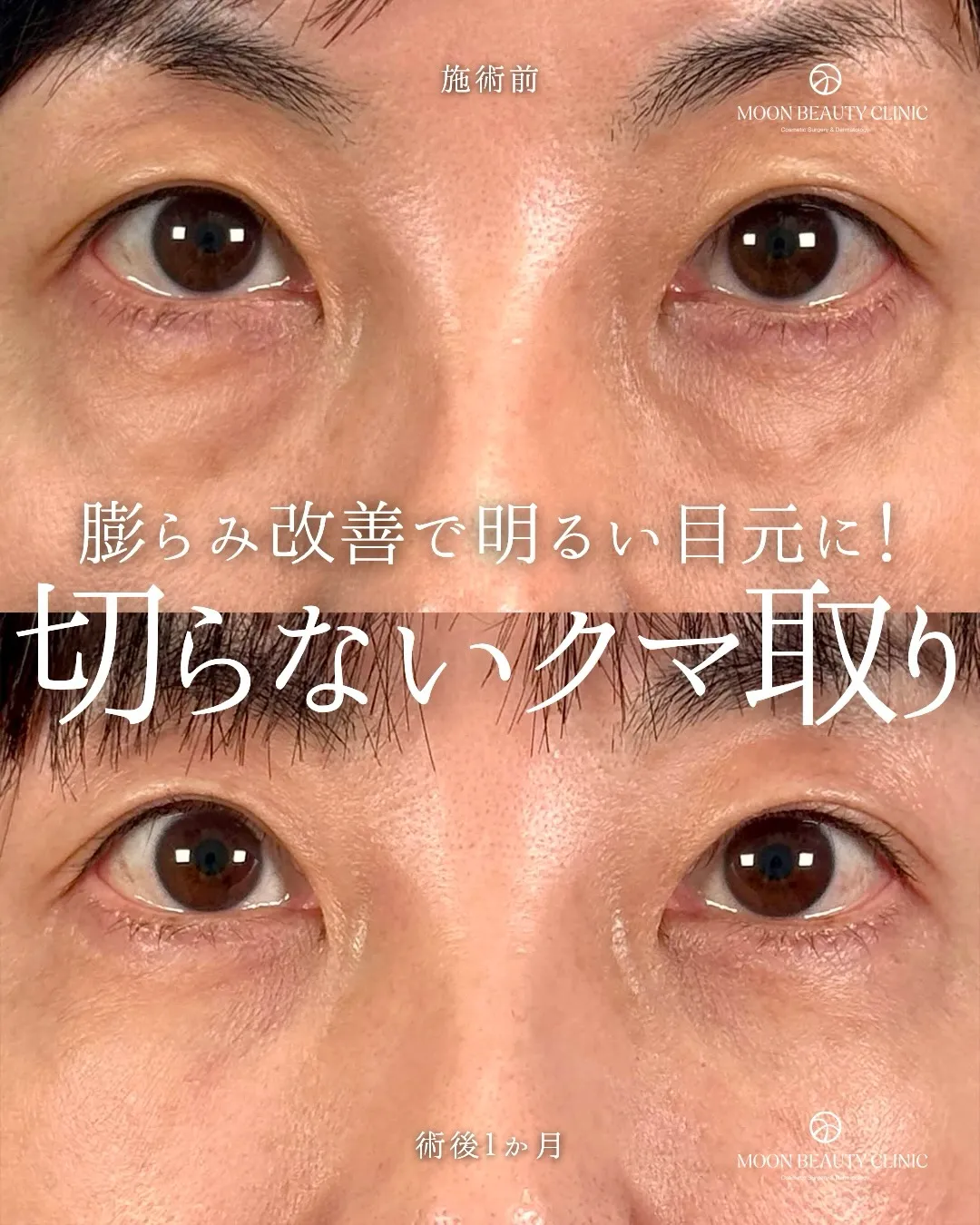 切らないクマ取り_7 Before/After