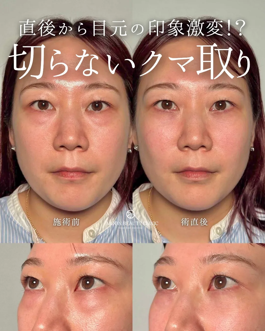 切らないクマ取り_8 Before/After