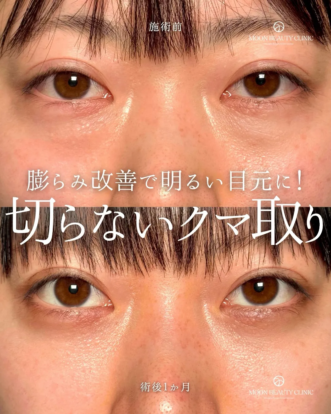 切らないクマ取り_9 Before/After