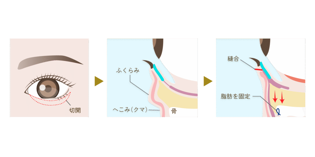 表ハムラ