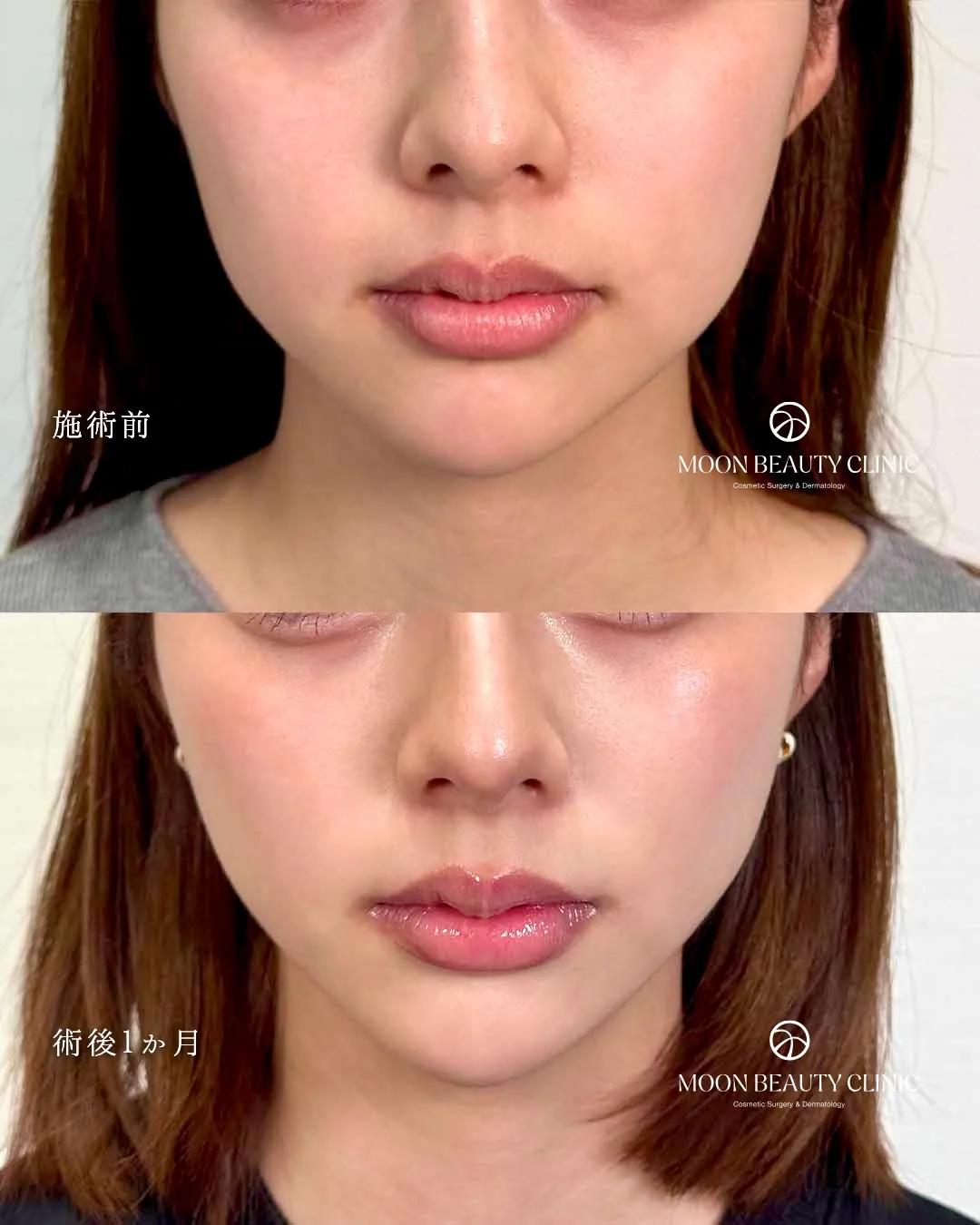 糸リフト_1 Before/After