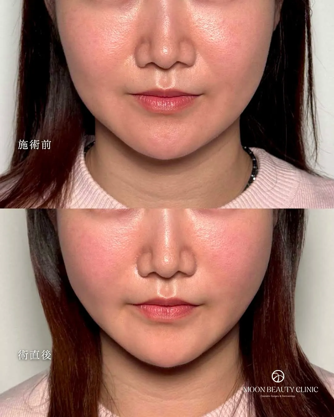 糸リフト_10 Before/After