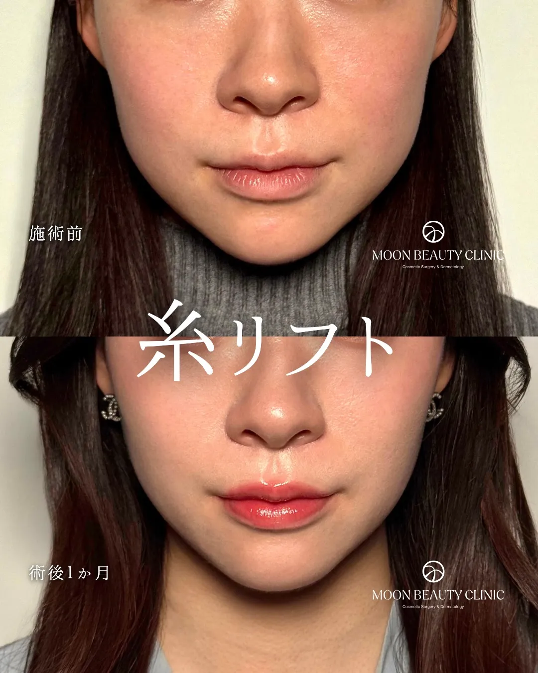糸リフト_2 Before/After