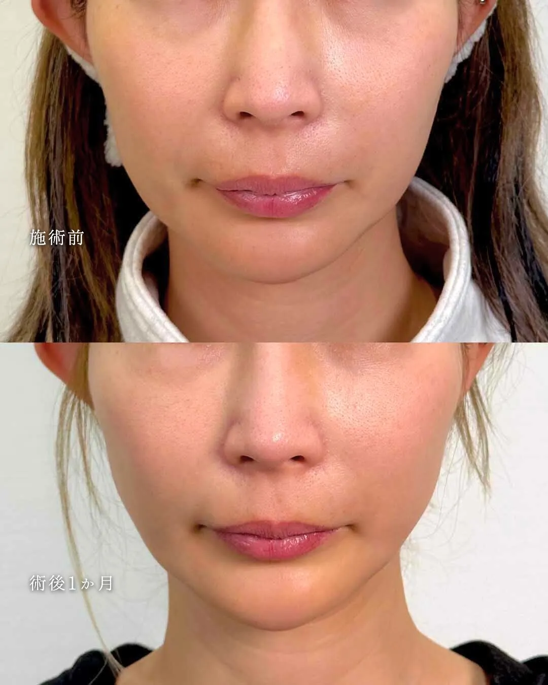 糸リフト_3 Before/After