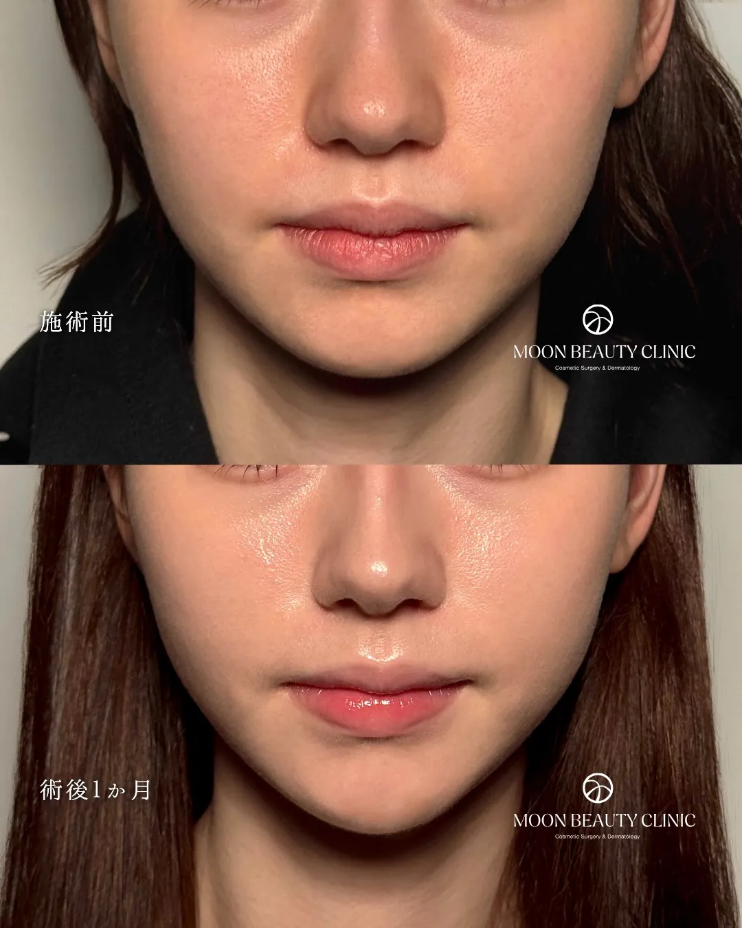 糸リフト_4 Before/After