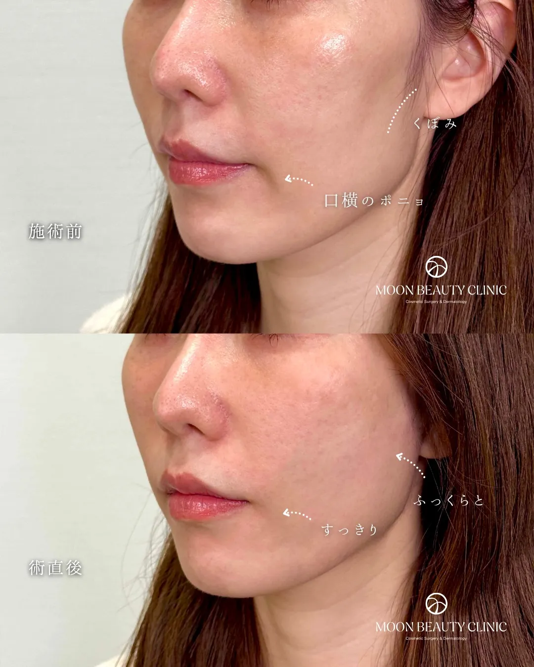 糸リフト_5 Before/After