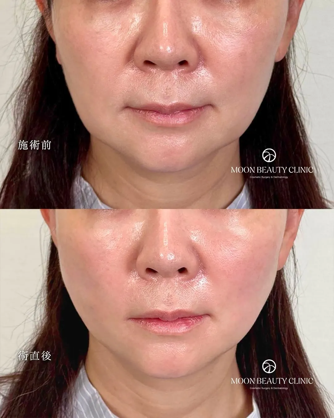 糸リフト_7 Before/After