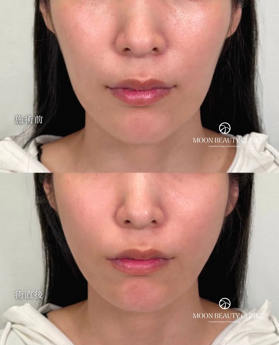 糸リフト_8 Before/After