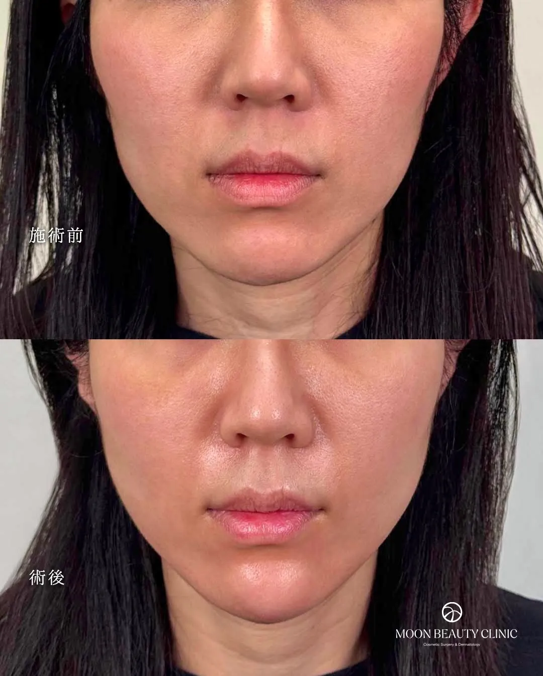糸リフト_9 Before/After
