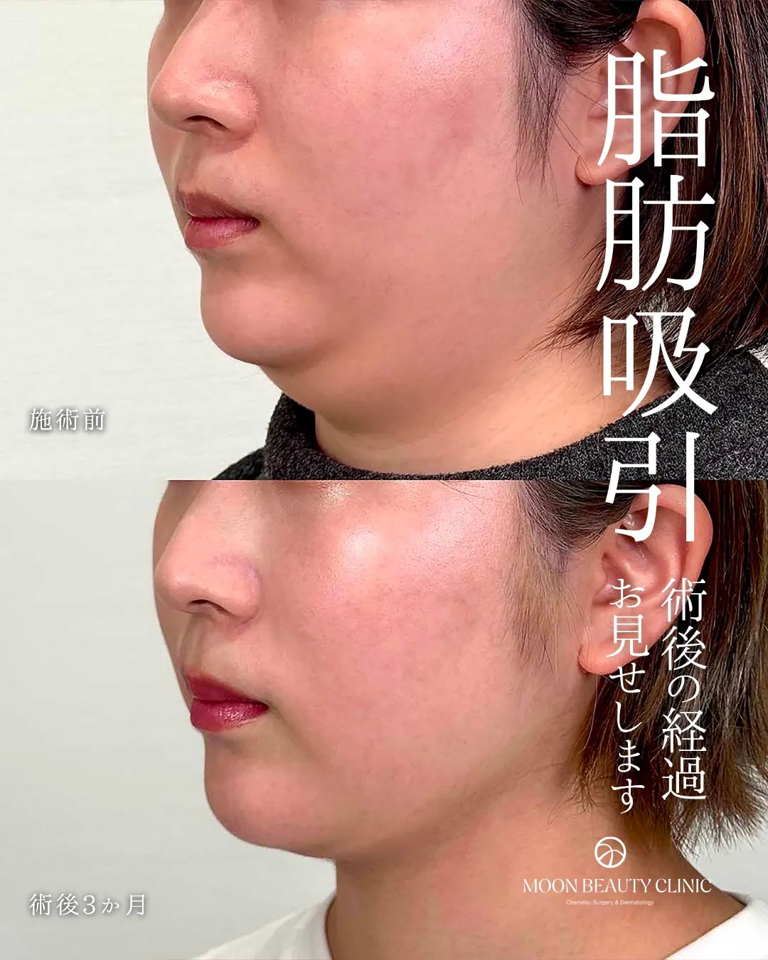 顎下脂肪吸引 Before/After