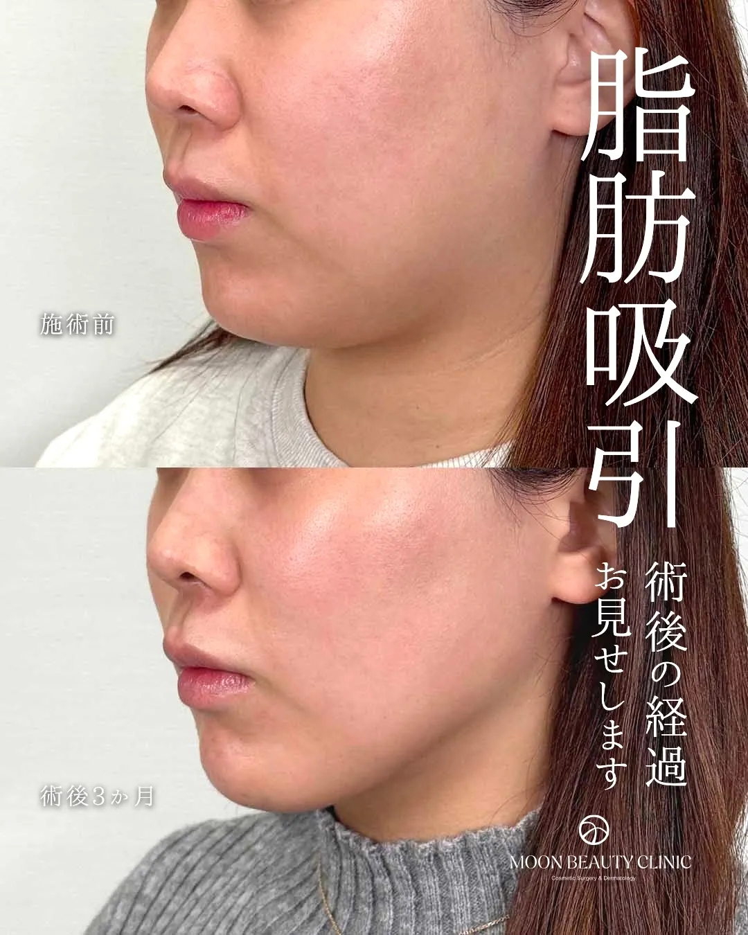 顎下脂肪吸引＋糸リフト_1 Before/After