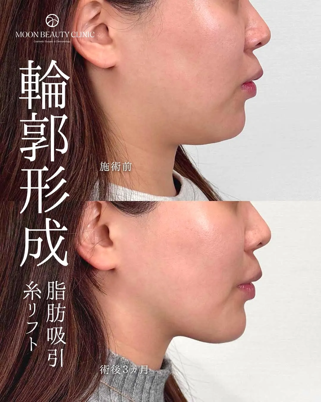顎下脂肪吸引＋糸リフト_2 Before/After