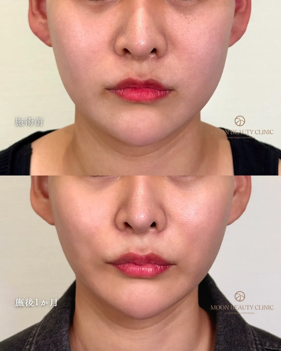 顎下脂肪吸引＋糸リフト_3 Before/After